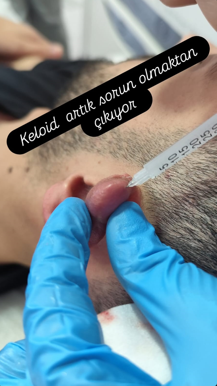 KELOİD TEDAVİSİ