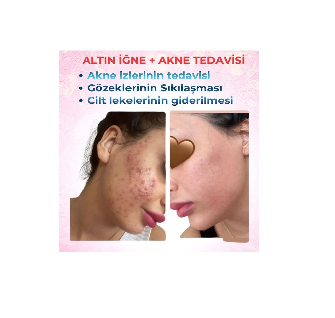 ALTIN İĞNE AKNE TEDAVİSİ