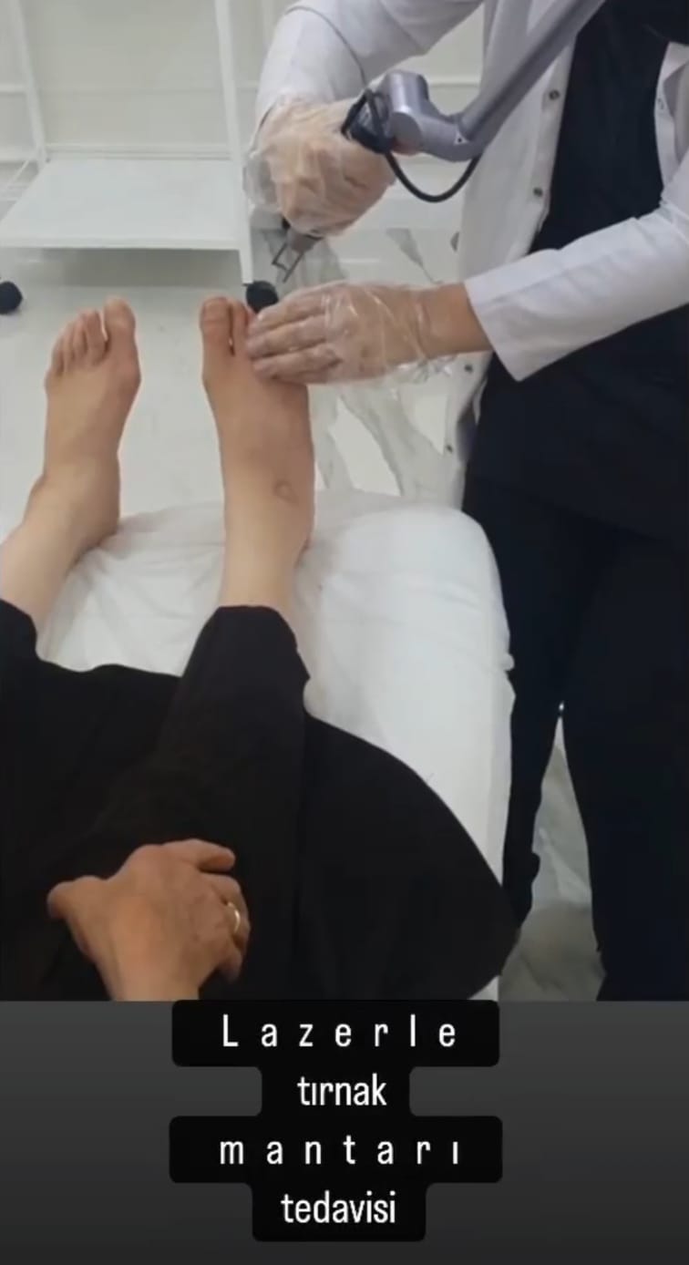 LAZER İLE TIRNAK MANTARI TEDAVİSİ