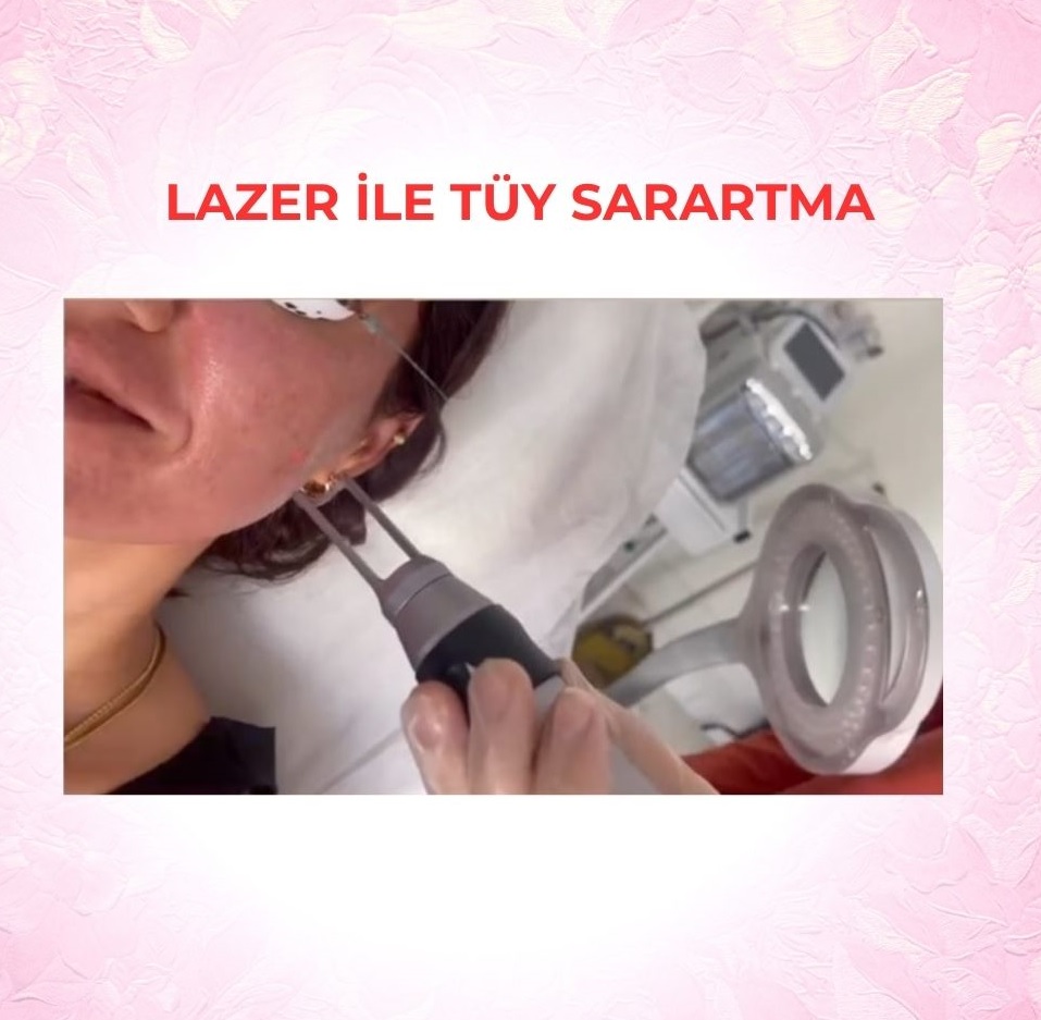 LAZER İLE TÜY SARARTMA